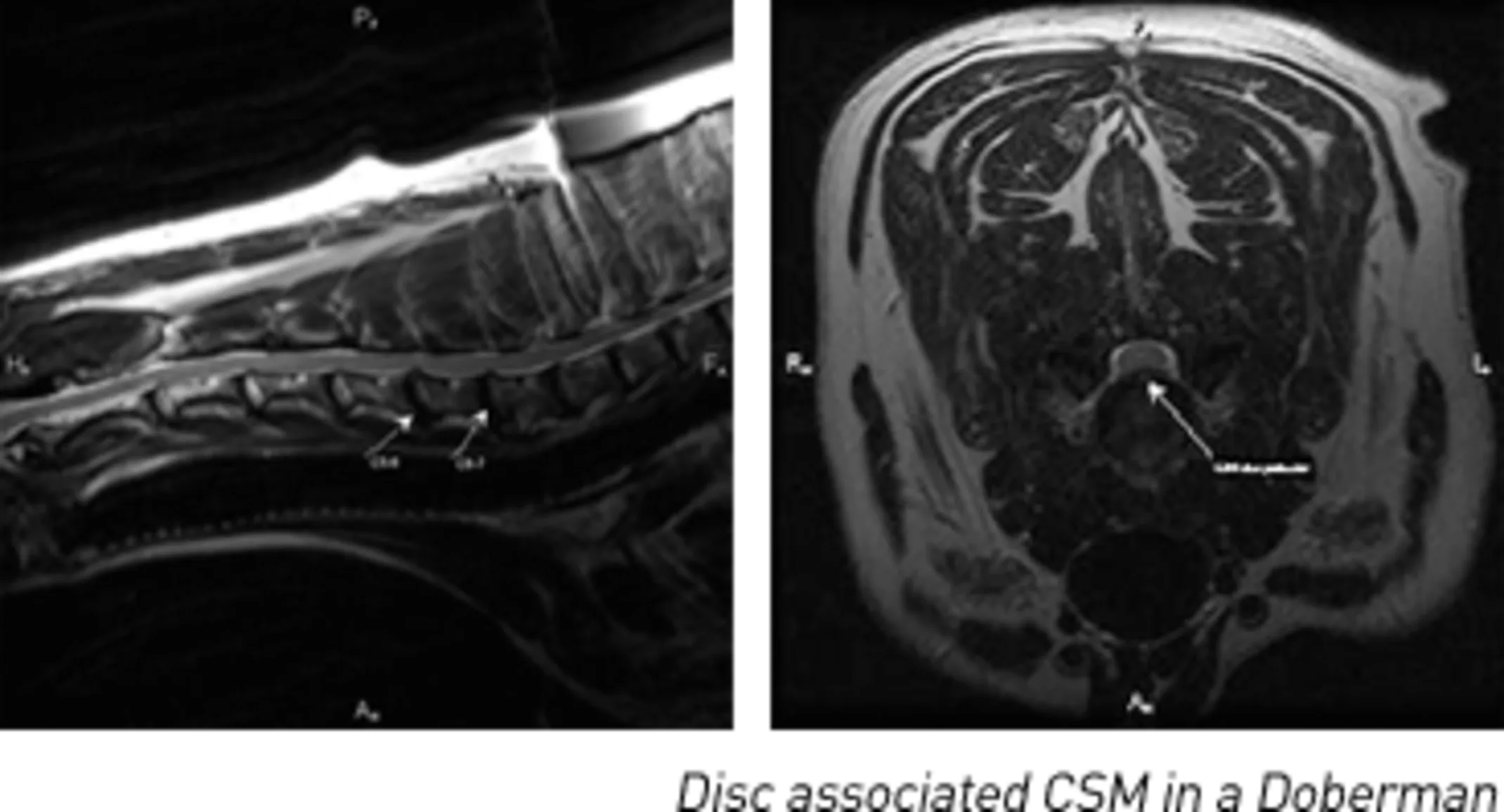 Cervical Spondylomyelopathy Cervical Spondylomyelopathy