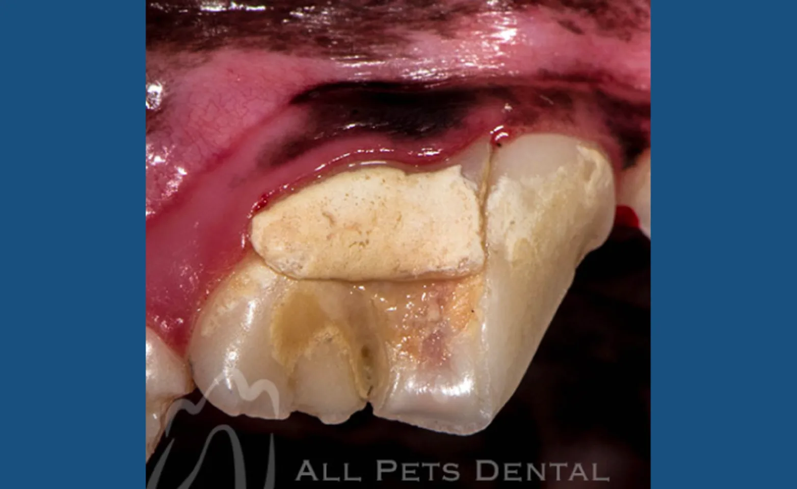 Complicated Crown Root Fracture