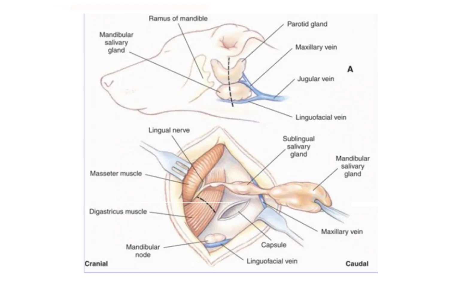 Mandibular and Sublingual Sialadenectomy Mandibular and Sublingual Sialadenectomy