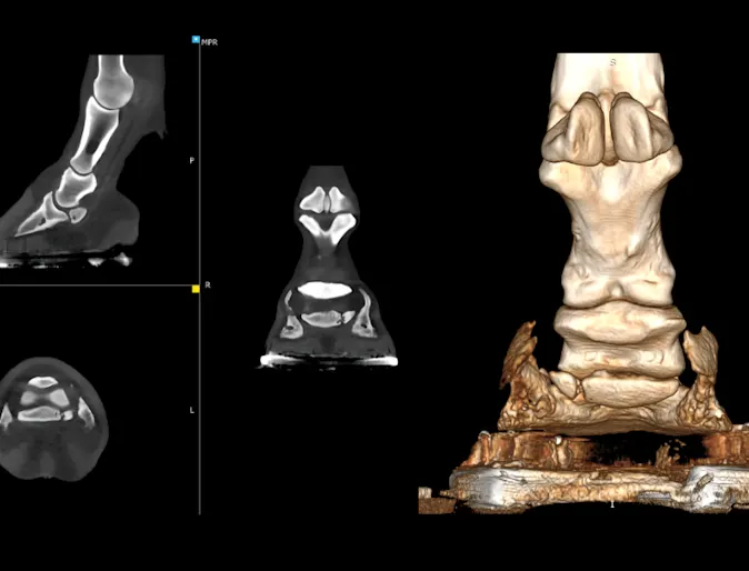CT scan images of Fractured Navicular Bone CT scan images of Fractured Navicular Bone