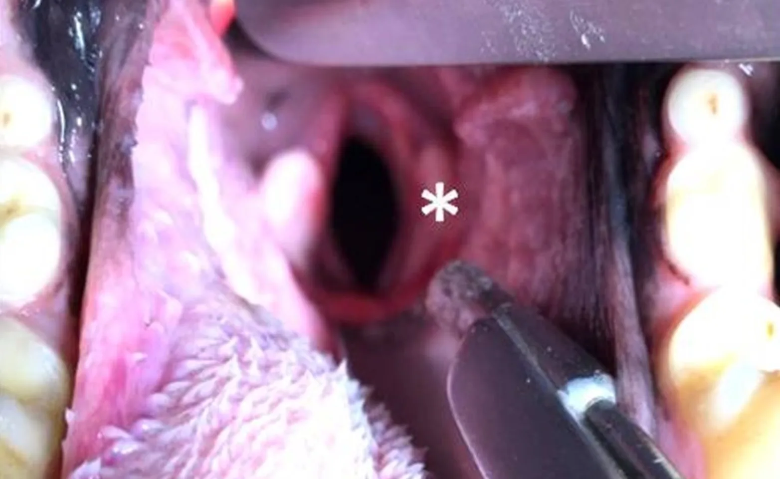 Intra-oral examination of the larynx in a dog after unilateral arytenoid lateralization showing an enlarged laryngeal opening (black space). Intra-oral examination of the larynx in a dog after unilateral arytenoid lateralization showing an enlarged laryngeal opening (black space).