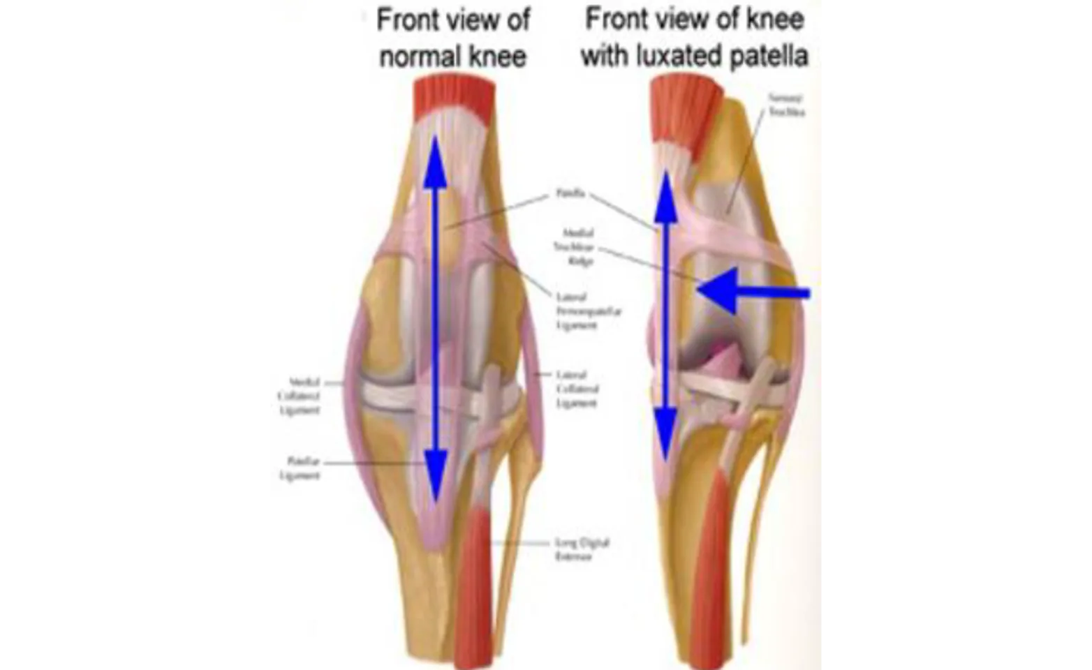 Front view of a normal knee and a knee with luxated patella Front view of a normal knee and a knee with luxated patella