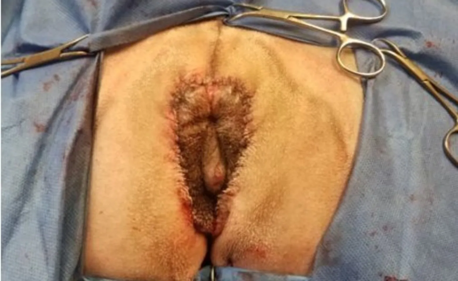 two crescent shaped incisions in the perivulvar skin two crescent shaped incisions in the perivulvar skin