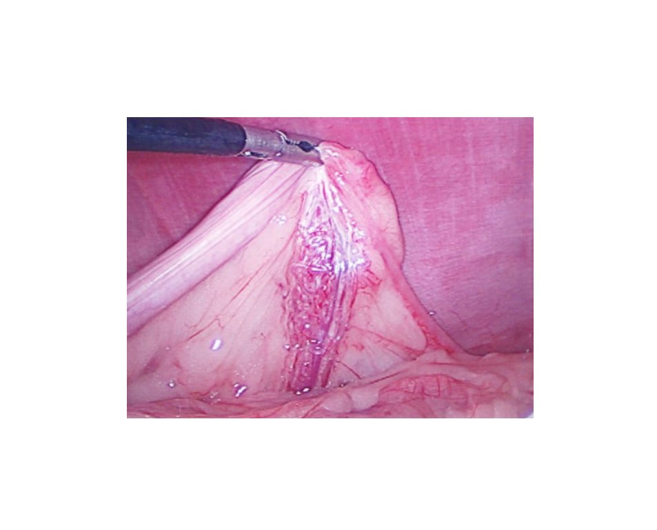 Ovary identified and pressed against abdominal wall