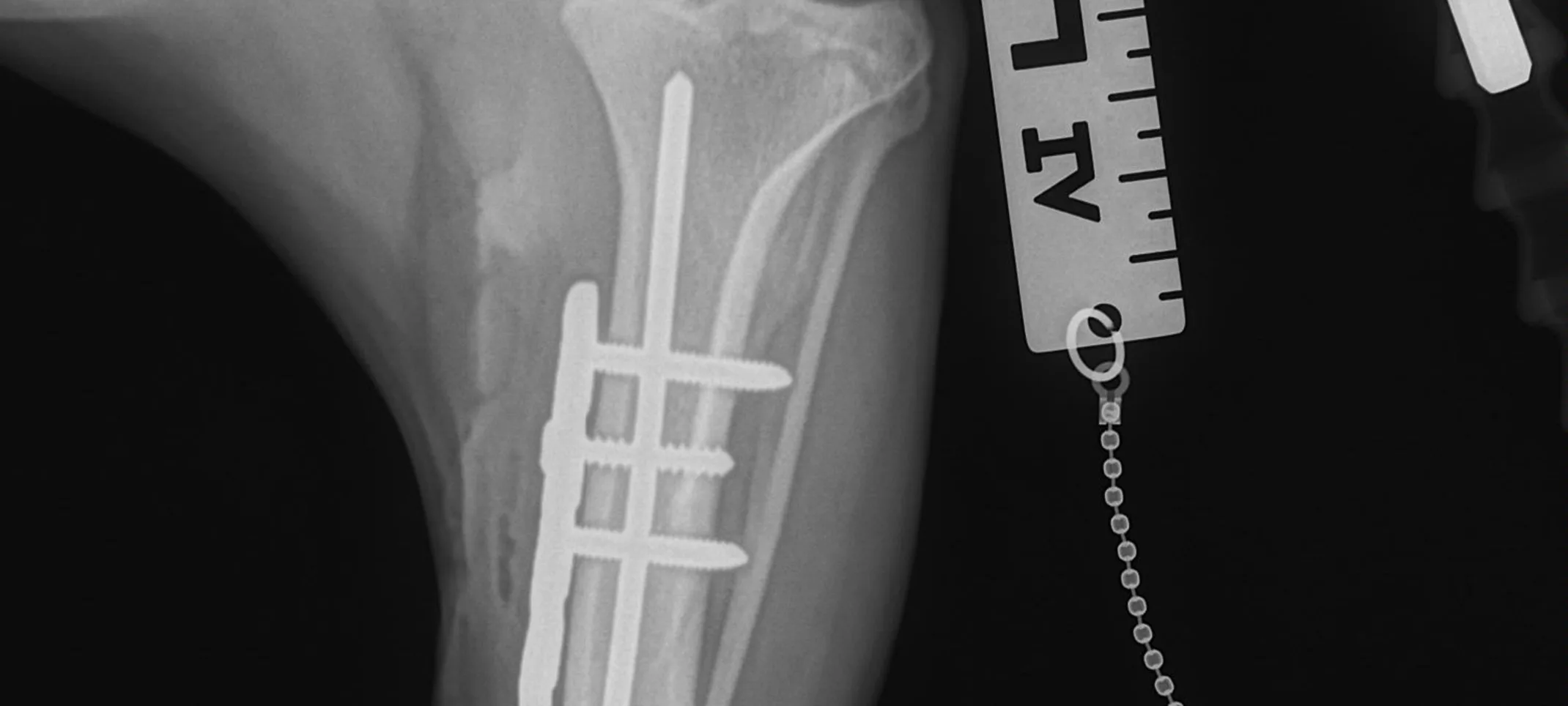 X-ray of bone plating X-ray of bone plating