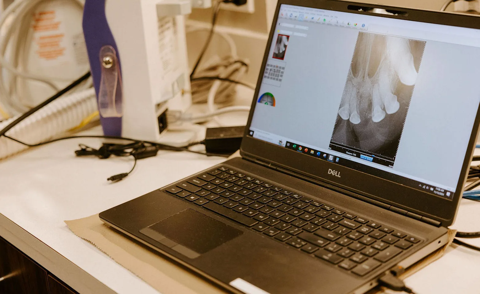 Picture of an x-ray on a laptop. Picture of an x-ray on a laptop.