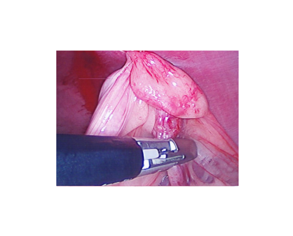  LigaSure device sealing and dividing tissue and blood vessels