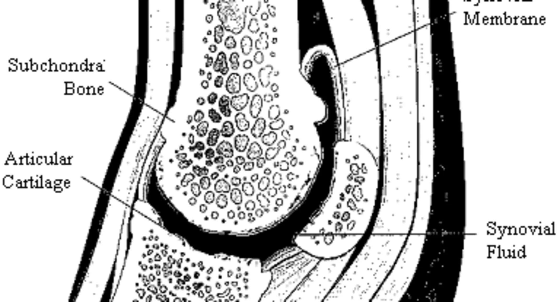Degenerative Joint Disease Illustration Degenerative Joint Disease Illustration