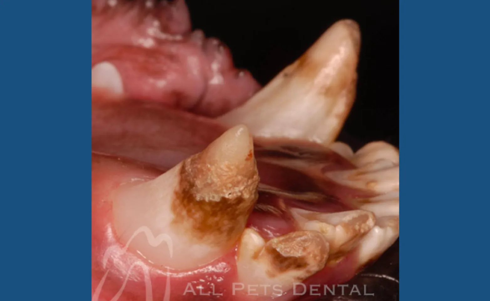 Enamel Hypoplasia Enamel Hypoplasia