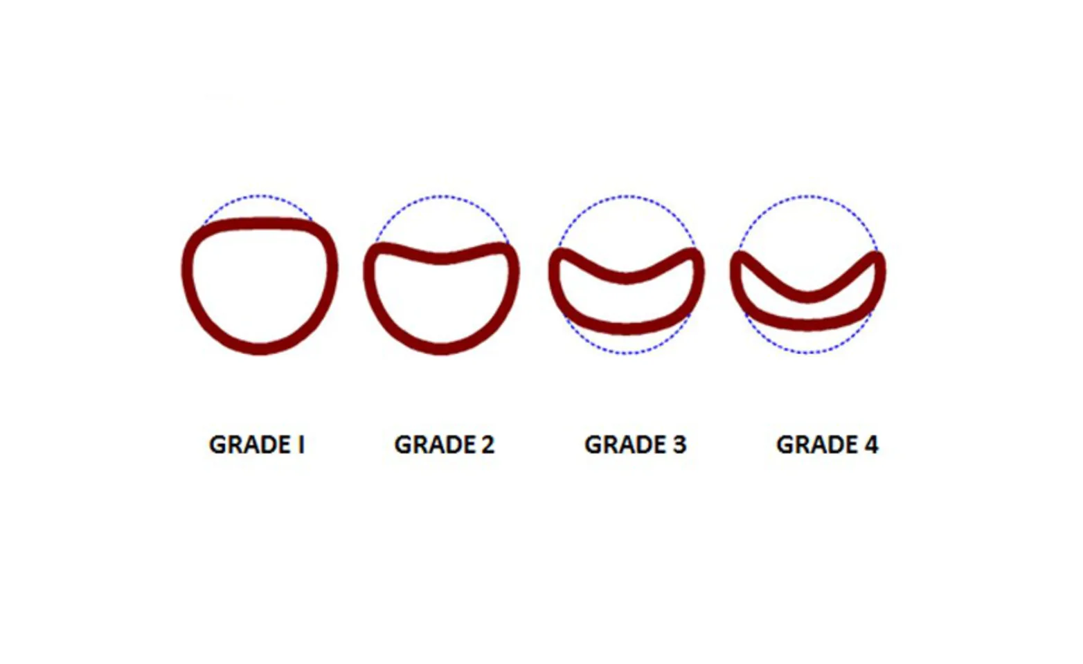 Lumen diagram Lumen diagram
