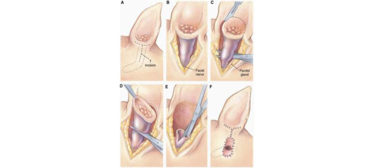Vertical Ear Canal Ablation