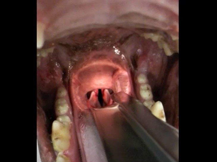  Thumbnail of a video showing a laryngeal exam of a dog with laryngeal paralysis performed under light sedation.