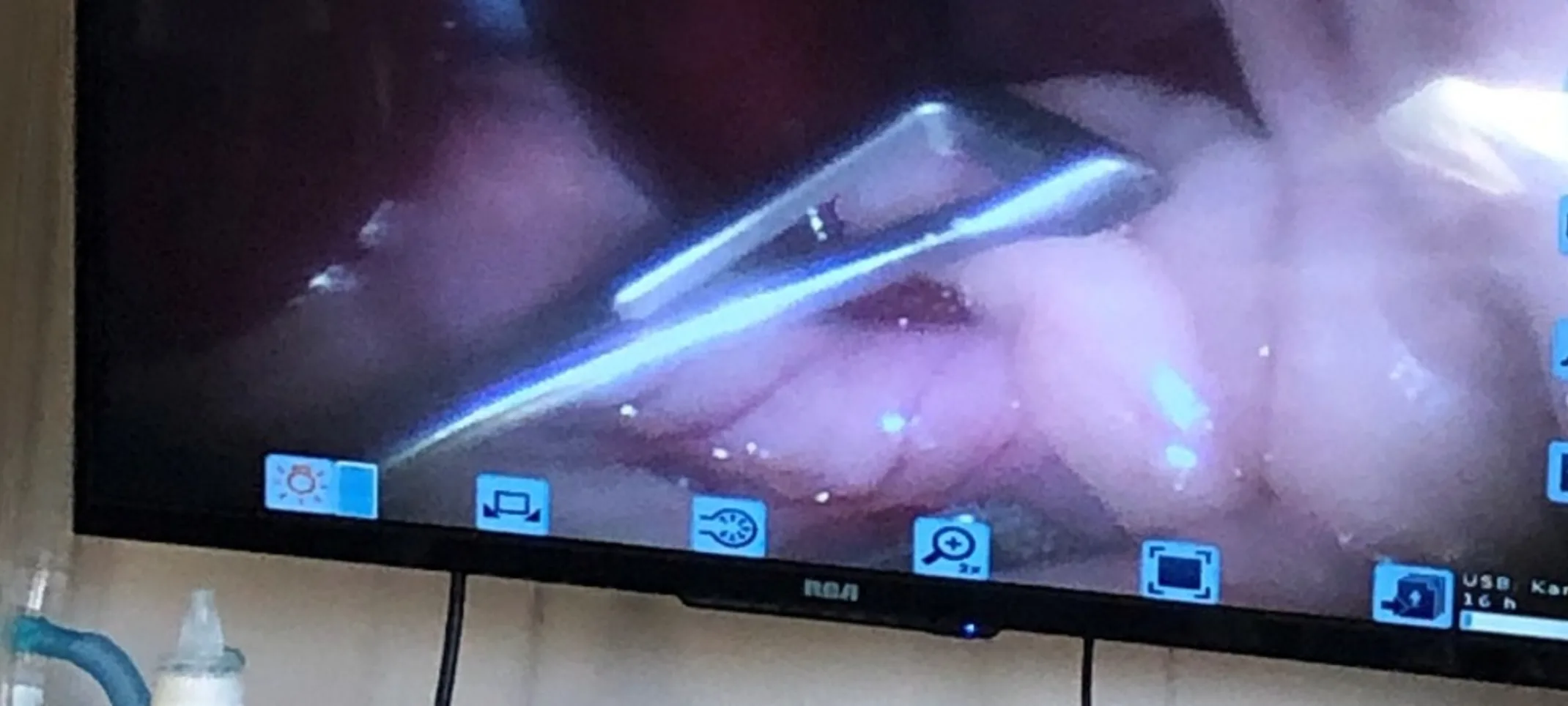 Screen view of Laparoscopic Surgery.