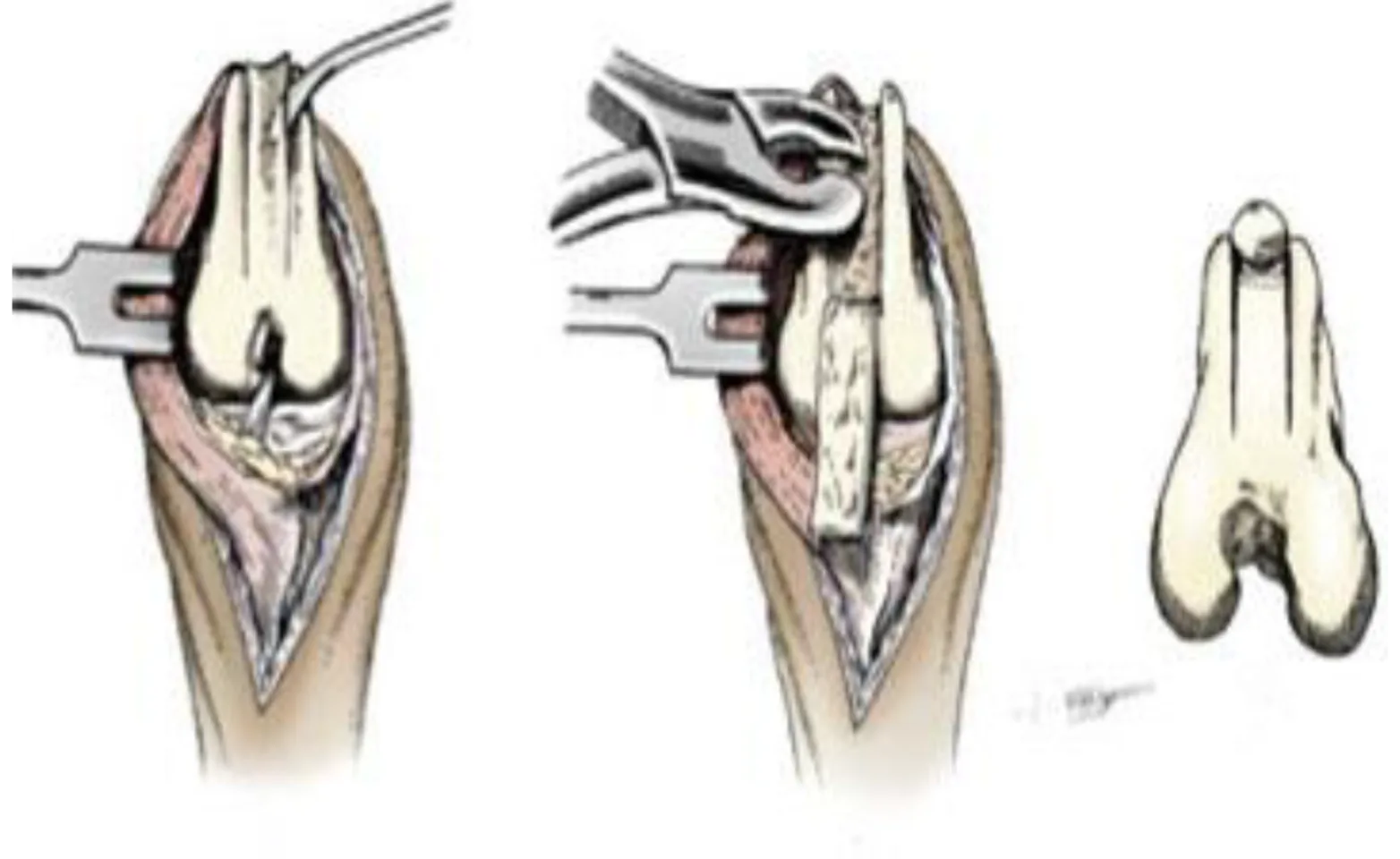 Illustration of deepening of the femoral groove Illustration of deepening of the femoral groove