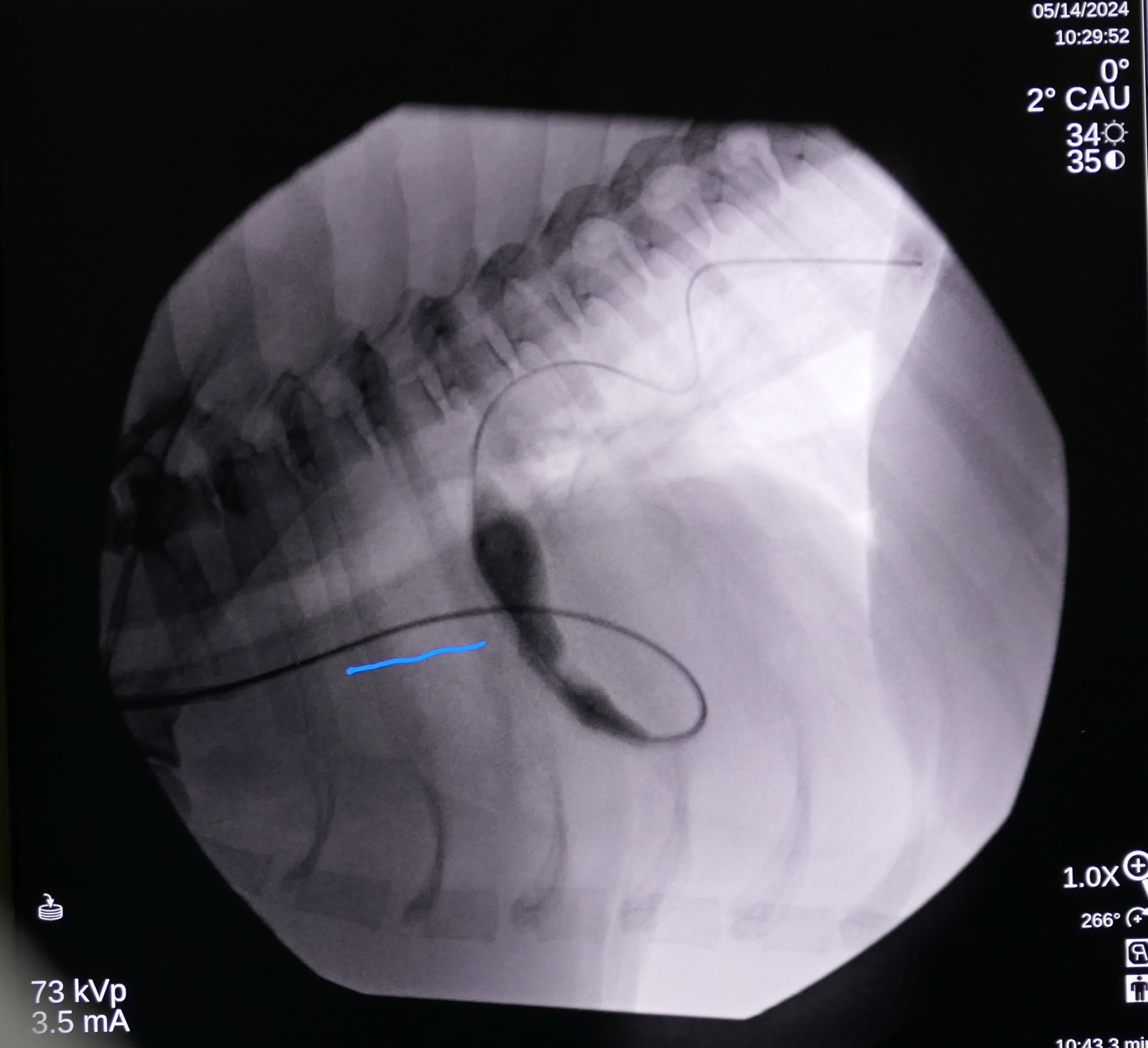 An x-ray of balloon valvuloplasty. 