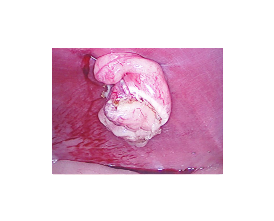  Healed tissue post operation