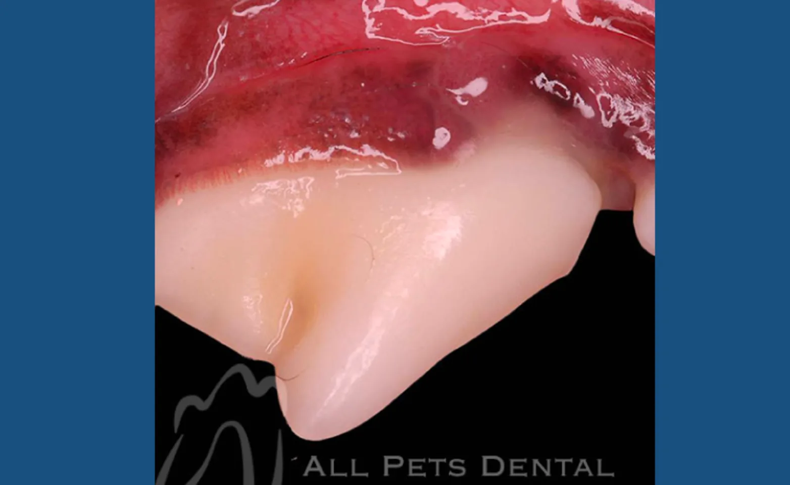 Stage 2 of Periodontal Disease Stage 2 of Periodontal Disease