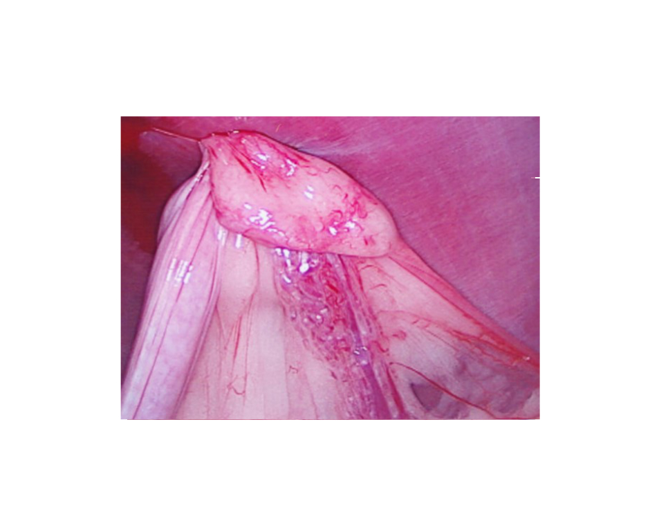 Ovary fixed to the abdominal wall