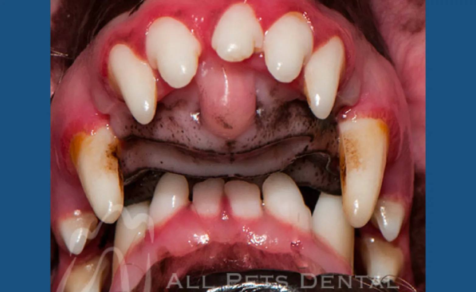 Mandibular Disoclusion Mandibular Disoclusion