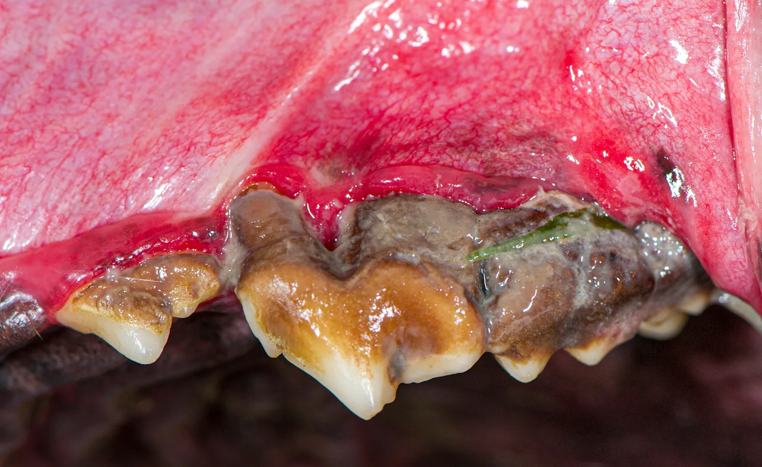 Stage 4 of Periodontal Disease Stage 4 of Periodontal Disease
