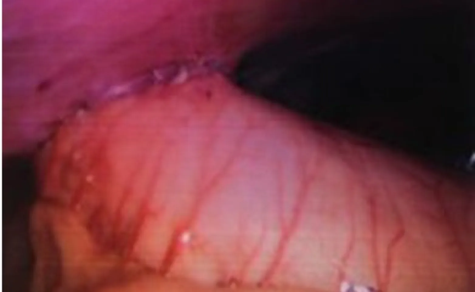 completed gastropexy, as seen by the laparoscope completed gastropexy, as seen by the laparoscope