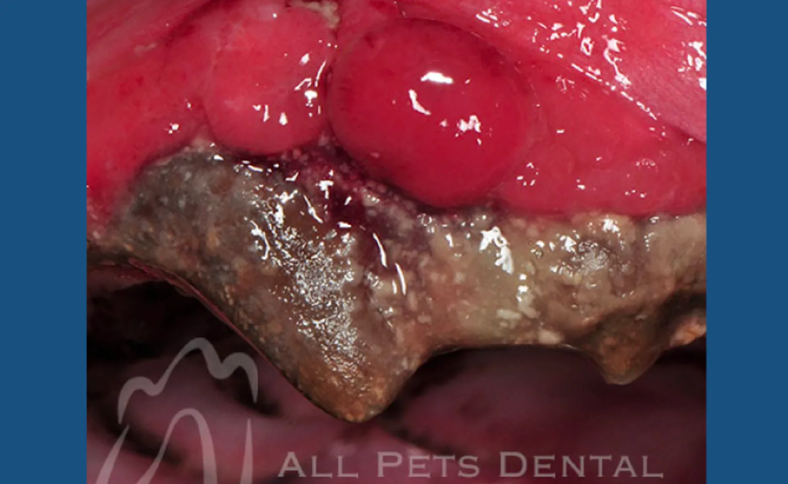 Plasmacytoma Plasmacytoma