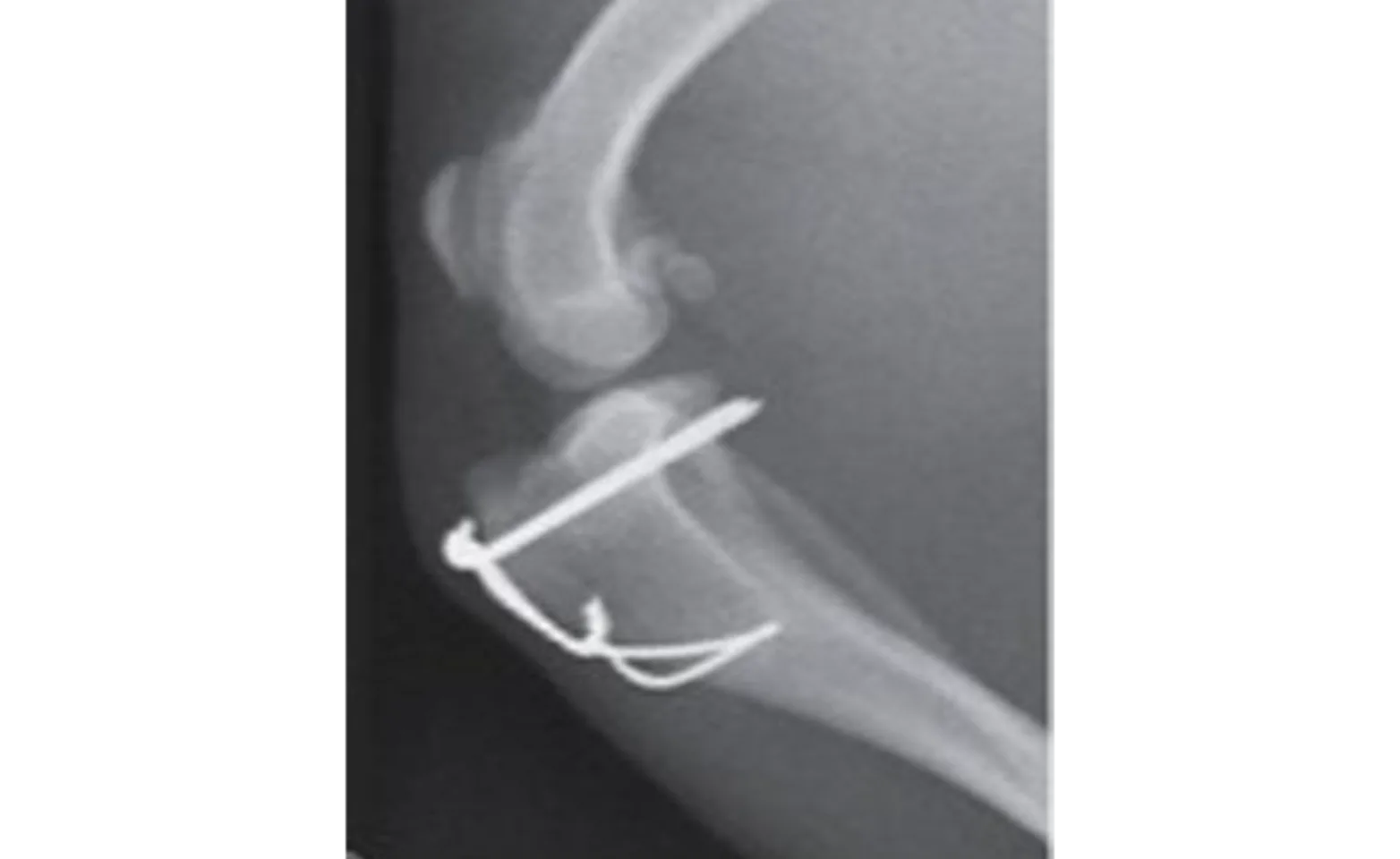 A tibial tuberosity transposition A tibial tuberosity transposition