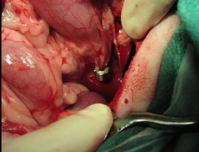 Ameroid constrictor placed around a shunting vessel Ameroid constrictor placed around a shunting vessel