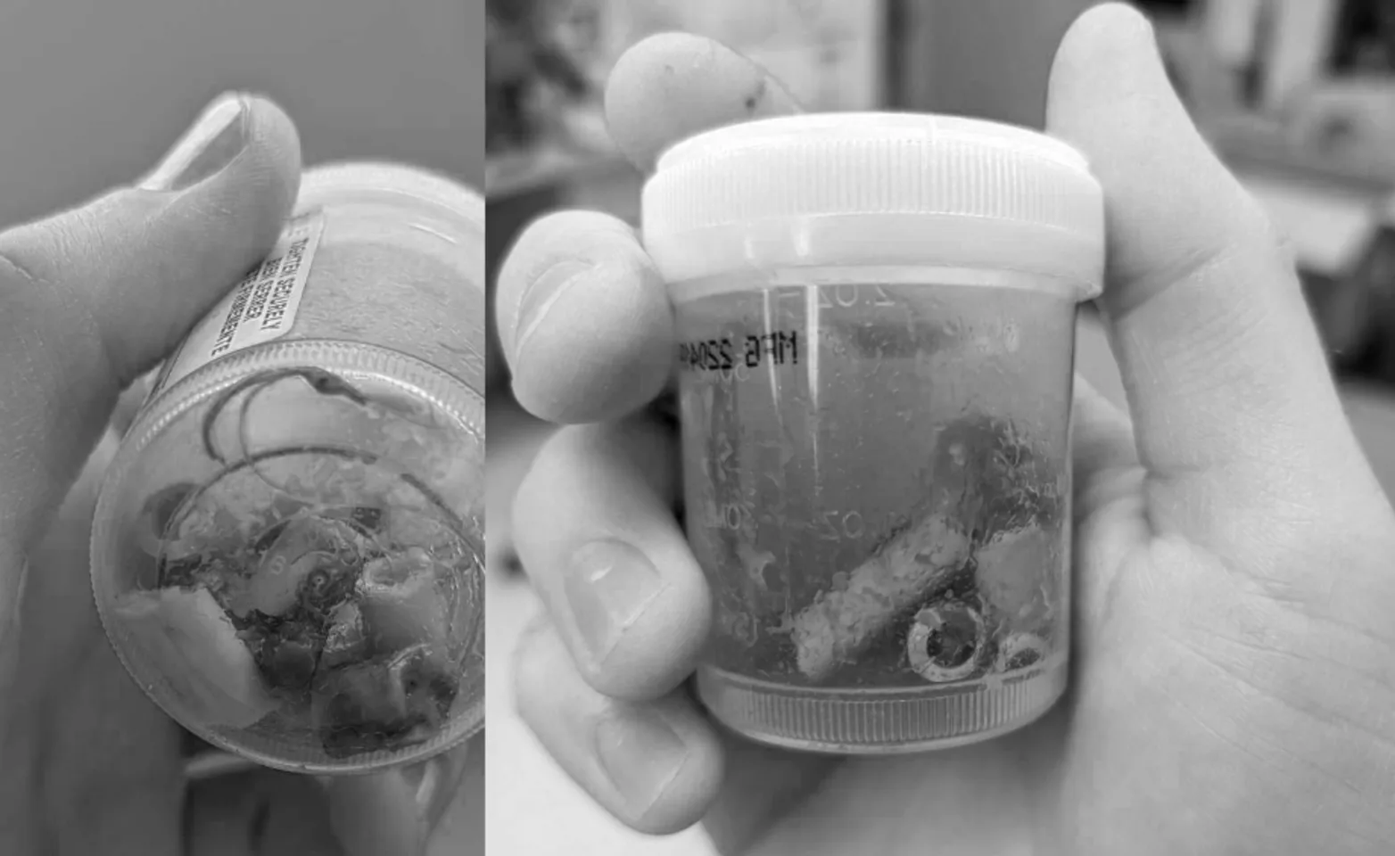 A black & white photo of Todd's intestinal blockage A black & white photo of Todd's intestinal blockage