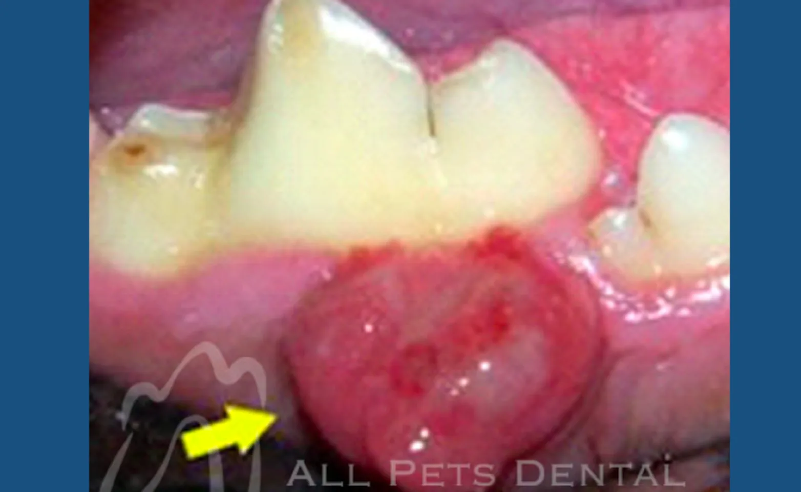 Acanthomatus Ameloblastoma Acanthomatus Ameloblastoma