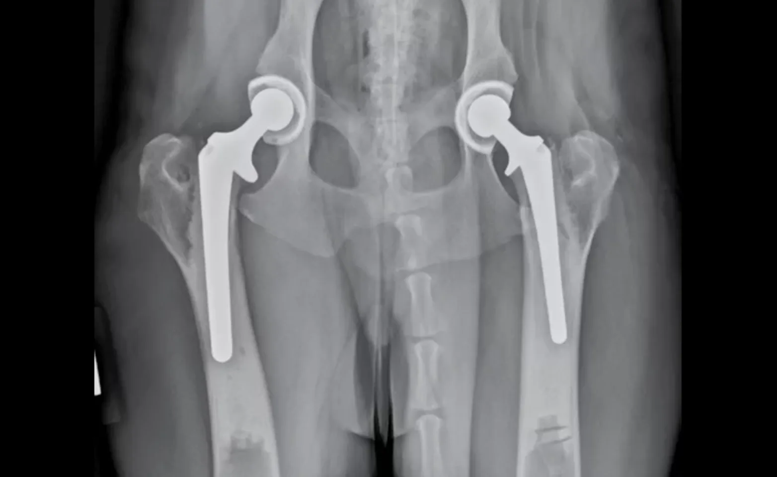 Radiograph (x-ray) showing a hybrid total hip replacement Radiograph (x-ray) showing a hybrid total hip replacement