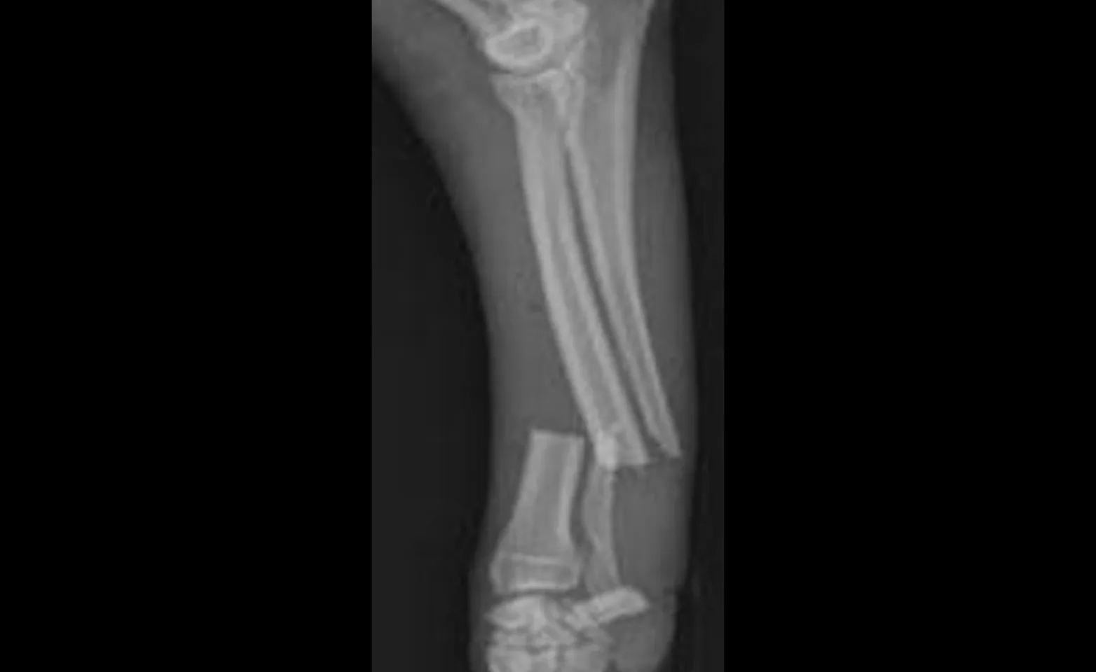 Diagram of a fractured bone Diagram of a fractured bone