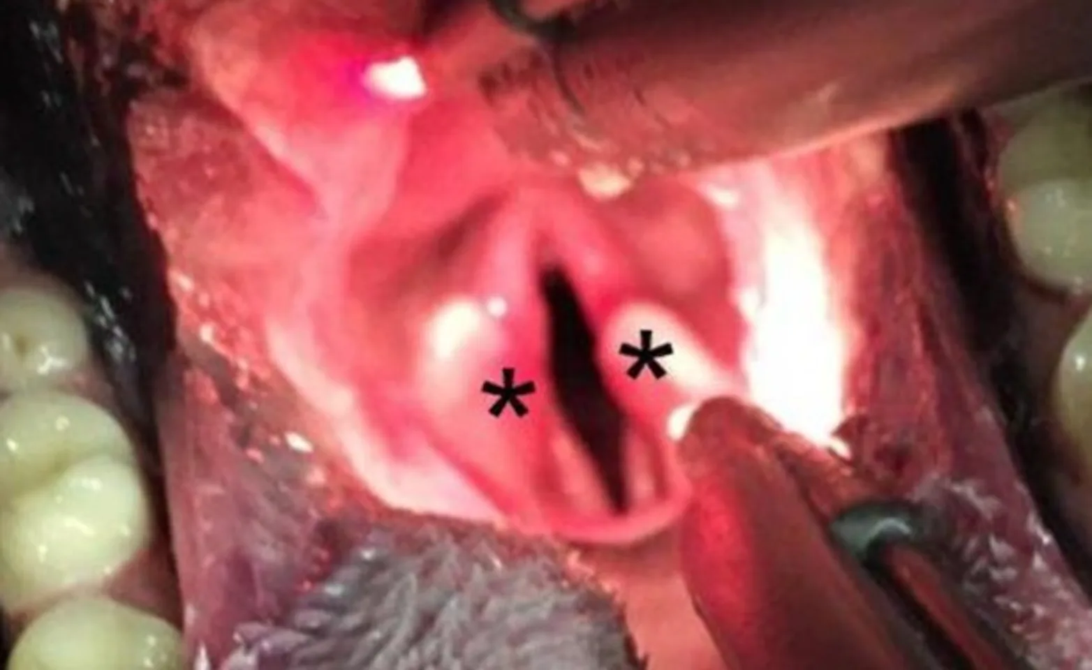 Intra-oral examination of the larynx in a dog with laryngeal paralysis under light sedation. The laryngeal opening into the trachea (black space) is narrowed and the arytenoid cartilages (asterisks) failed to open during inhalation. Intra-oral examination of the larynx in a dog with laryngeal paralysis under light sedation. The laryngeal opening into the trachea (black space) is narrowed and the arytenoid cartilages (asterisks) failed to open during inhalation.