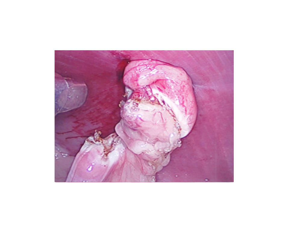  Tissue and blood vessels divided and sealed