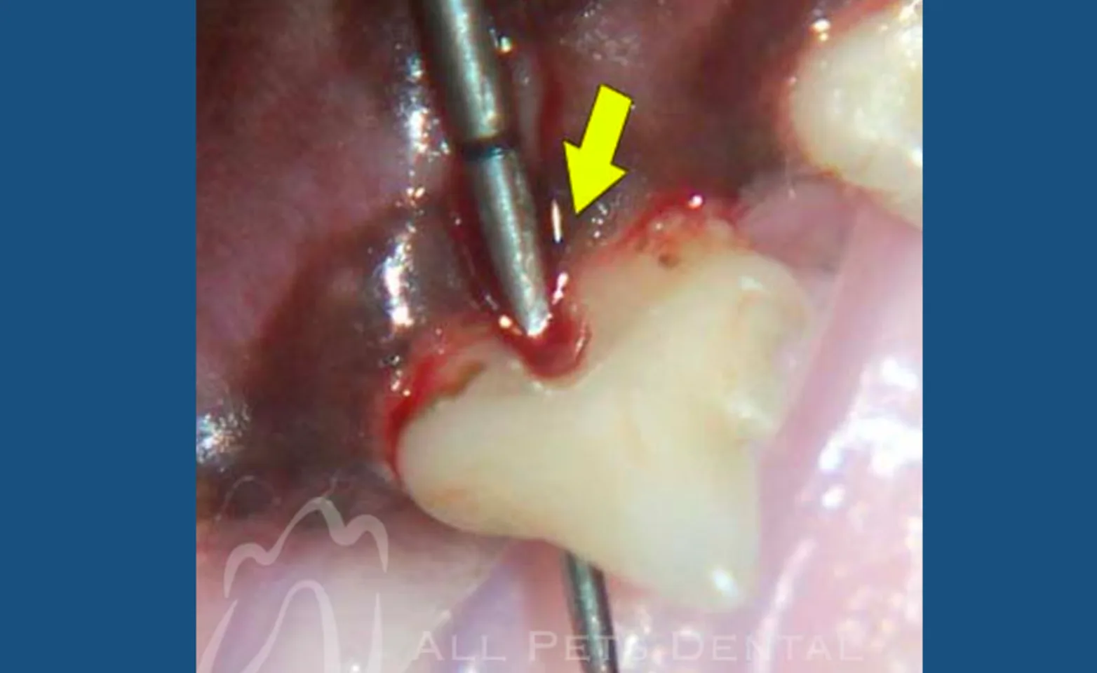 Furcation Exposure Furcation Exposure