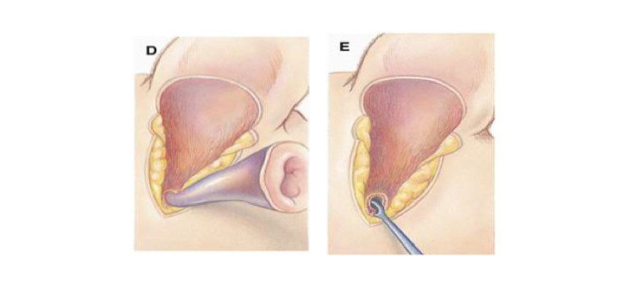 The ear canal is then sharply separated from its attachment to the external acoustic meatus (opening to the middle ear).