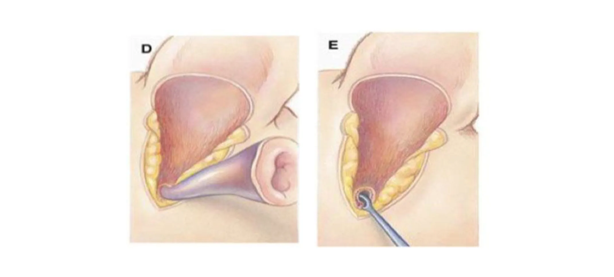 The ear canal is then sharply separated from its attachment to the external acoustic meatus (opening to the middle ear). The ear canal is then sharply separated from its attachment to the external acoustic meatus (opening to the middle ear).