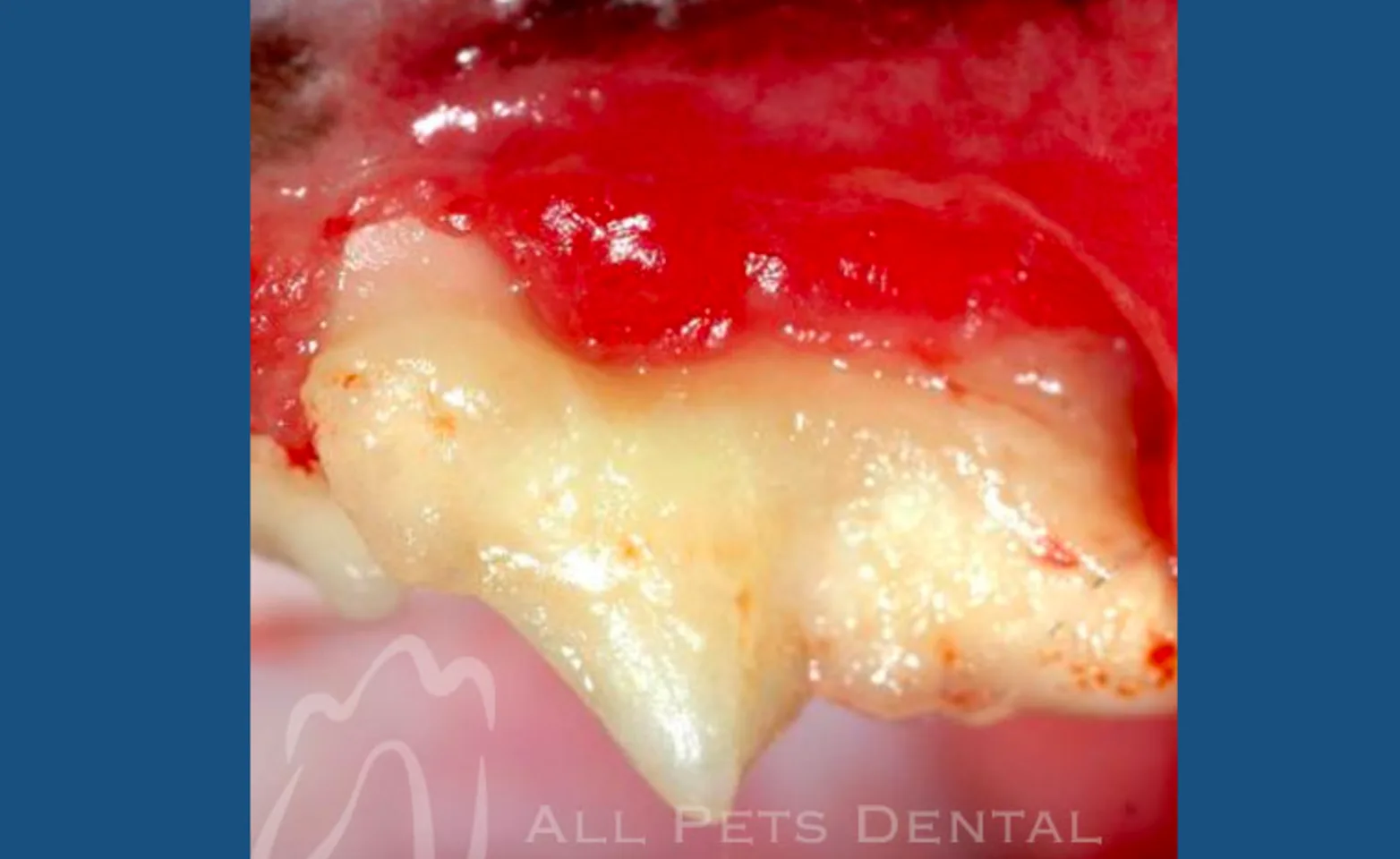Gingival Recession Gingival Recession