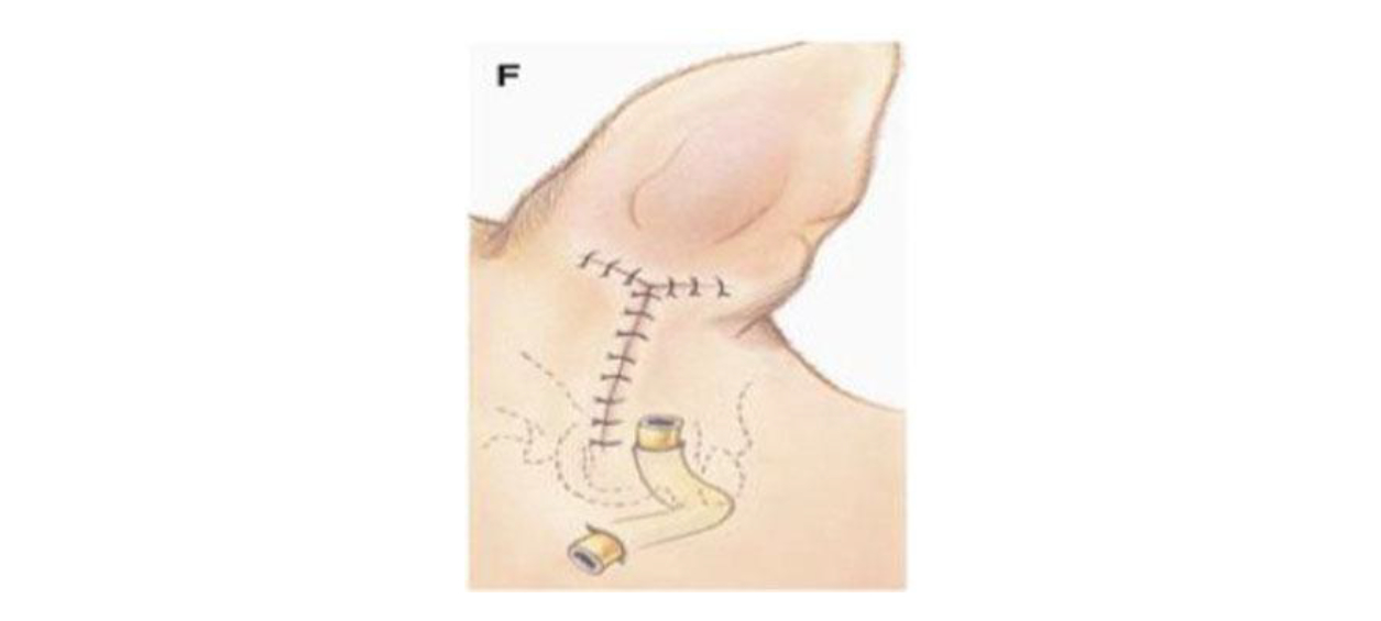 The incision is closed with suture material. A surgical drain may be placed depending on surgeon preference.
