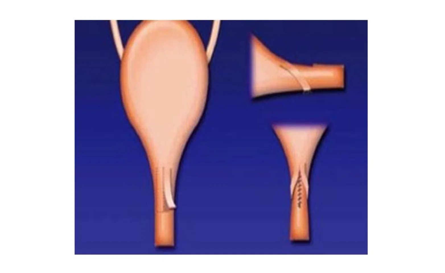 Urethral Sling. From McLoughlin and Chew’s “Surgical Views: Surgical Treatment of Urethral Sphincter Mechanism Incompetence in Female Dogs.” Compendium 2009. Urethral Sling. From McLoughlin and Chew’s “Surgical Views: Surgical Treatment of Urethral Sphincter Mechanism Incompetence in Female Dogs.” Compendium 2009.