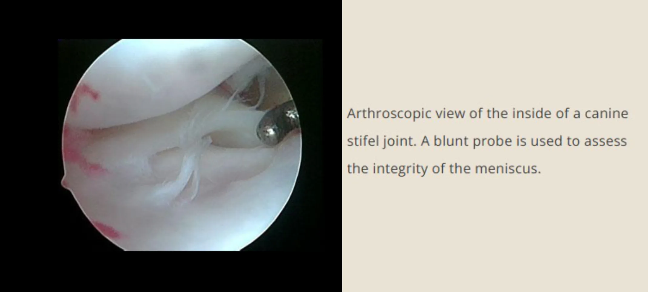 A blunt probe assessing the integrity of the meniscus A blunt probe assessing the integrity of the meniscus