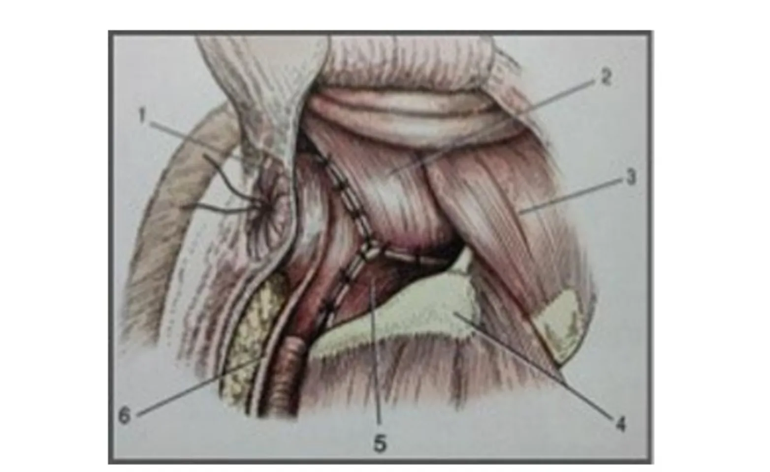 Suture placement for traditional herniorrhaphy (1, external anal sphincter; 2, coccygeus muscle; 3 superficial gluteal muscle; 4, ischial tuberosity; 5, internal obturator muscle; 6, retractor penis muscle) Suture placement for traditional herniorrhaphy (1, external anal sphincter; 2, coccygeus muscle; 3 superficial gluteal muscle; 4, ischial tuberosity; 5, internal obturator muscle; 6, retractor penis muscle)