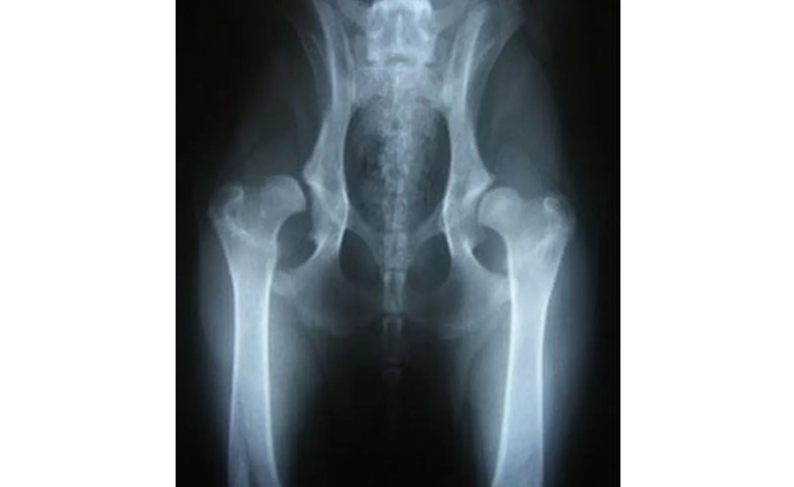Radiograph showing a young dog with severe hip subluxation secondary to joint laxity. Radiograph showing a young dog with severe hip subluxation secondary to joint laxity.