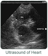 Ultrasound of Heart