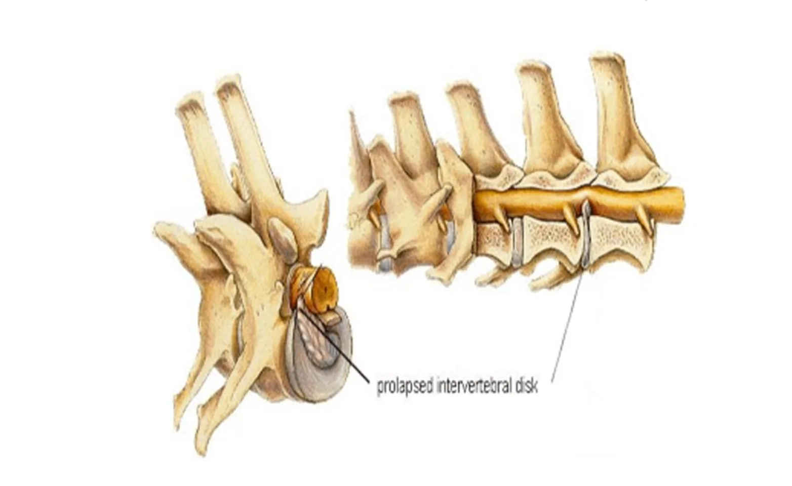 Illustration of intervertebral disk herniation Illustration of intervertebral disk herniation