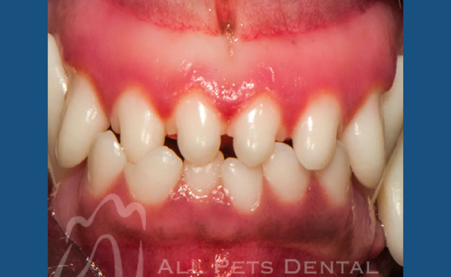 Rostral Crossbite Rostral Crossbite