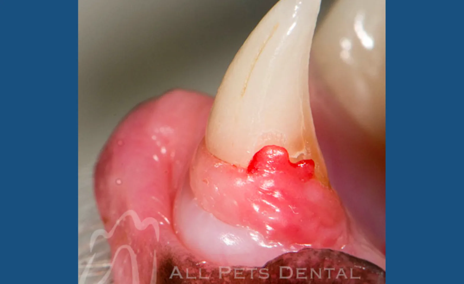 Tooth Resorption Stage 3