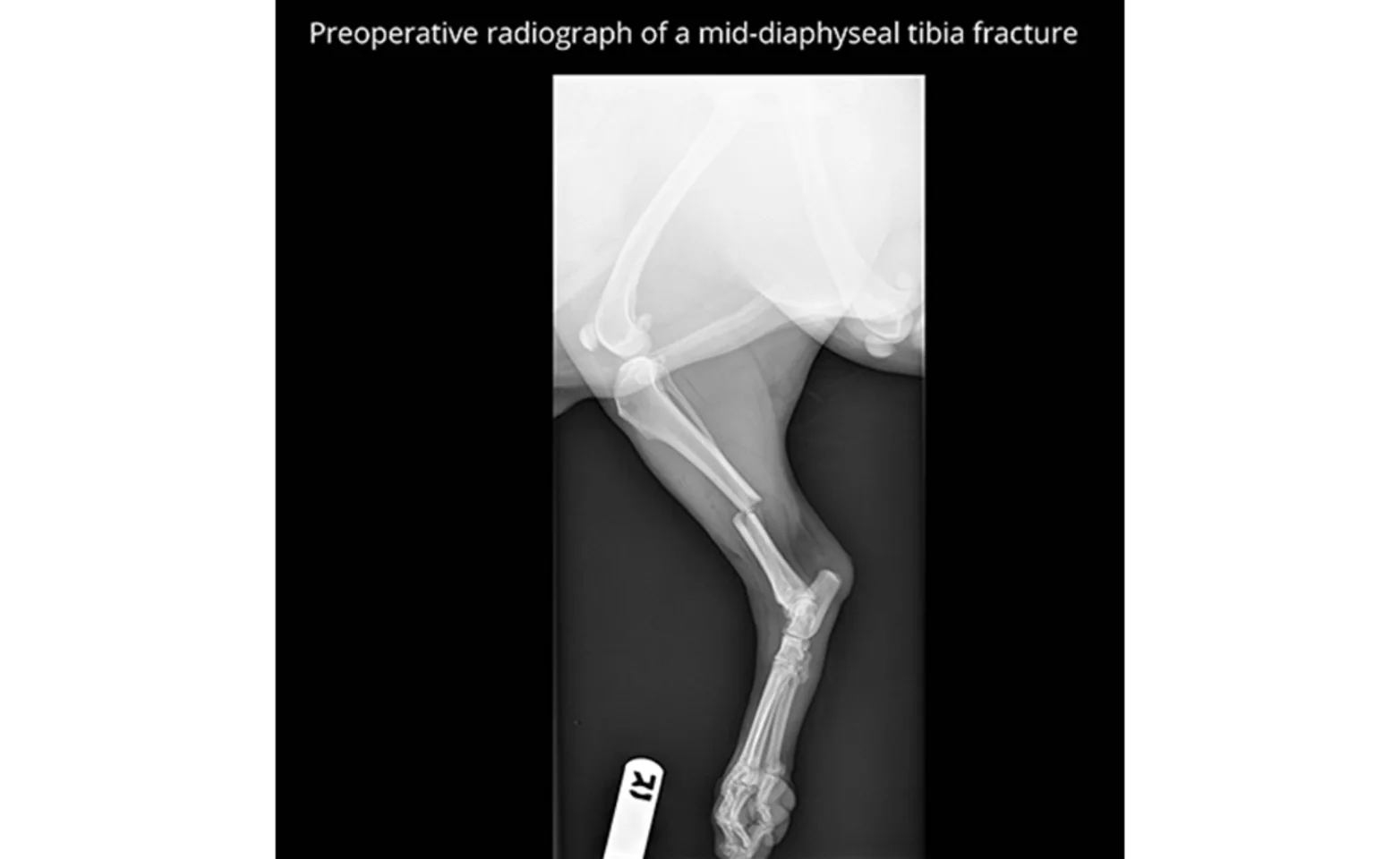 Preoperative Radiograph of a Mid-Diaphyseal Tibia Fracture X-Ray Preoperative Radiograph of a Mid-Diaphyseal Tibia Fracture X-Ray