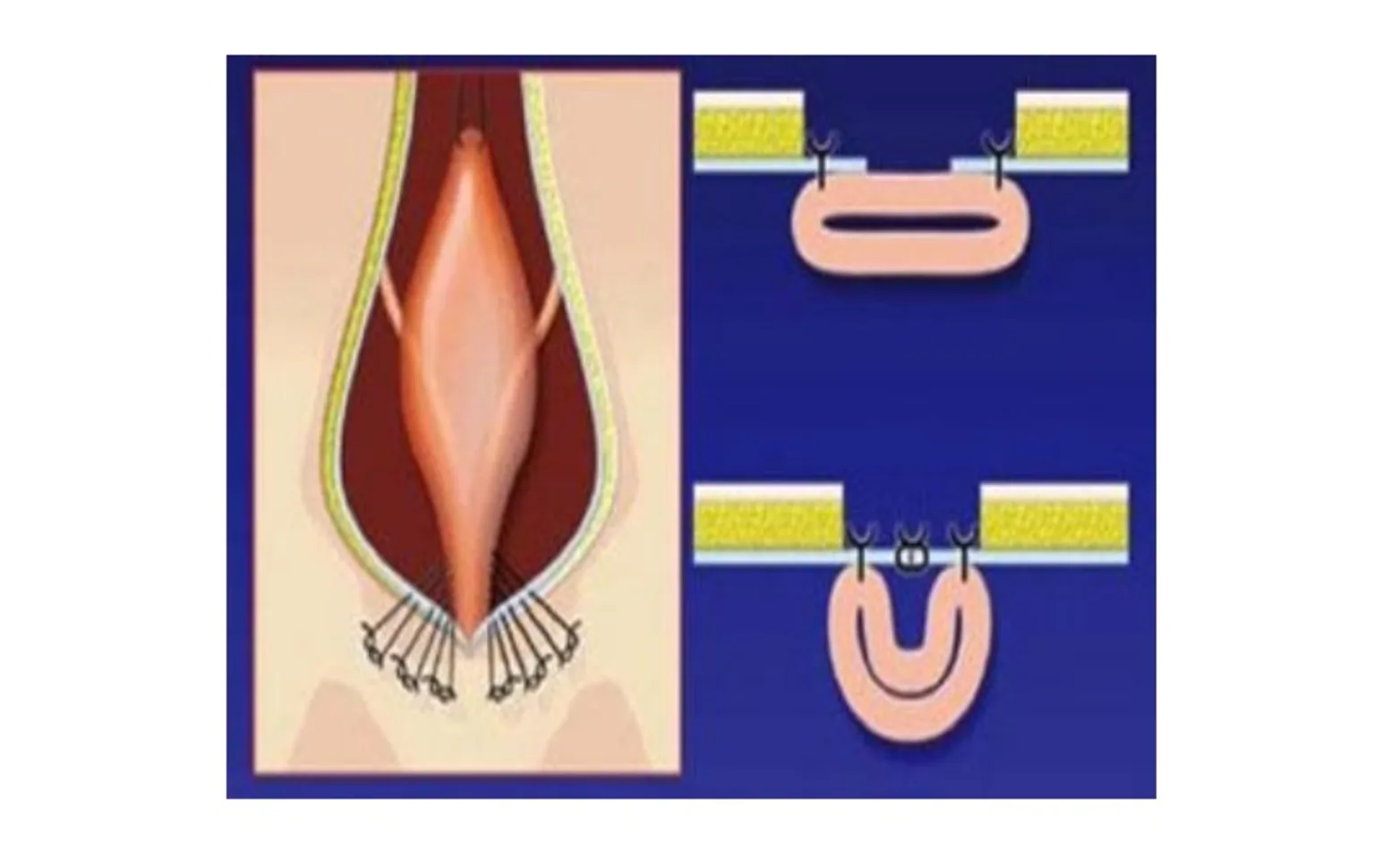 Step 2 of cystourethropexy, which involves pulling the bladder and urethra forward into the abdomen and suturing the urethra to the abdominal wall Step 2 of cystourethropexy, which involves pulling the bladder and urethra forward into the abdomen and suturing the urethra to the abdominal wall