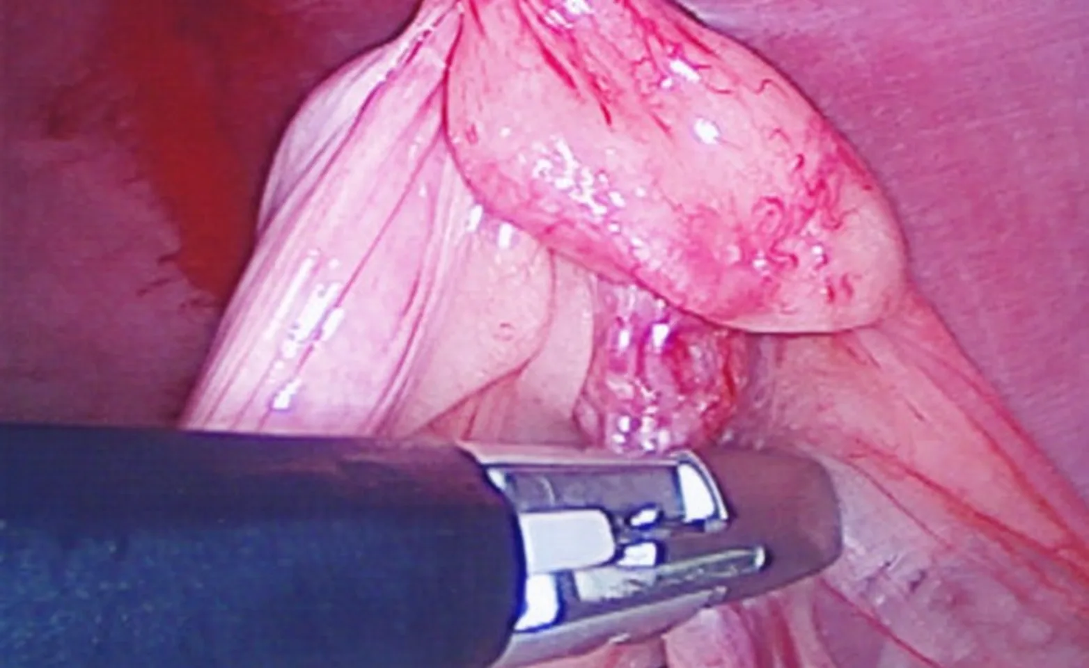 special cauterization and cutting device used to remove organs special cauterization and cutting device used to remove organs